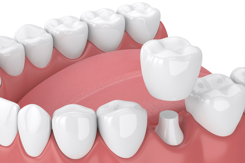 Dental Crowns in Wasilla