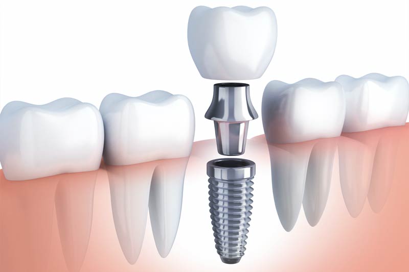Implants Dentist in Wasilla