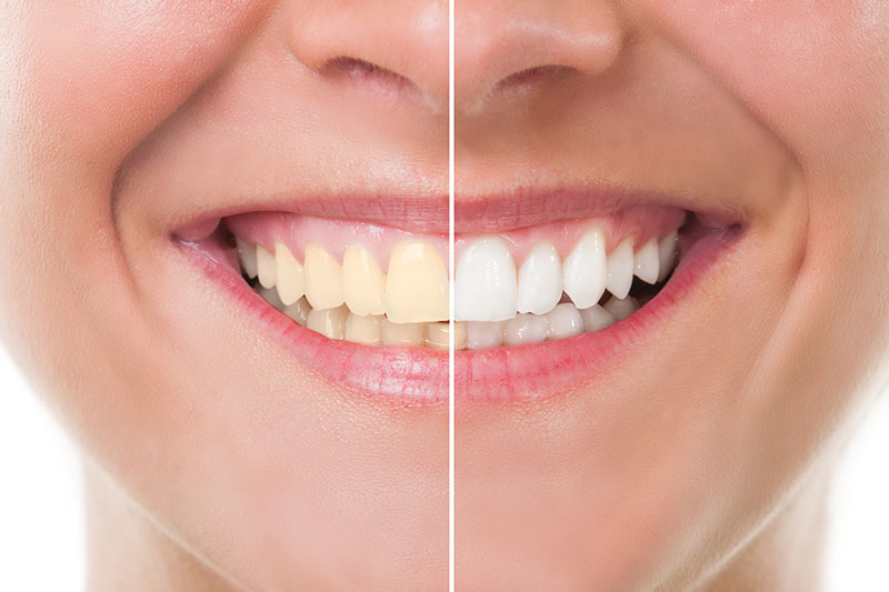 Teeth Whitening in Wasilla