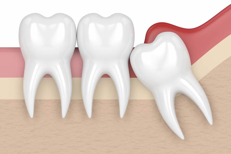 Wisdom Tooth Removal in Wasilla